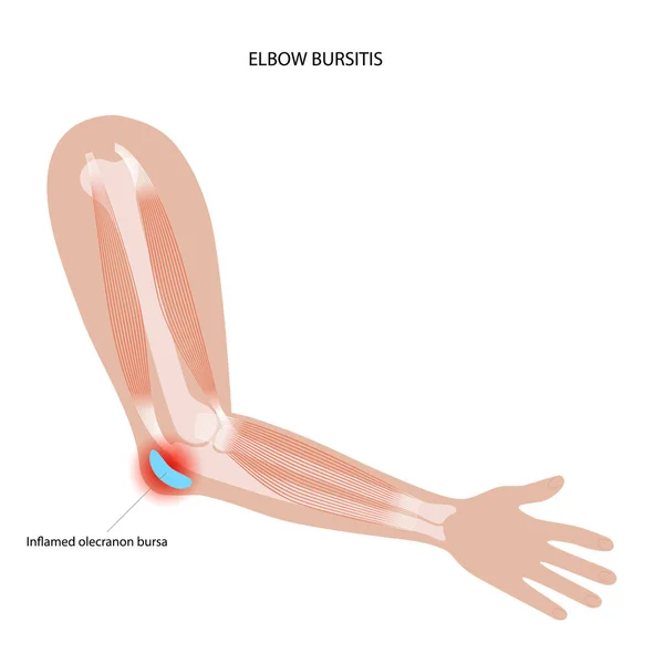 Bursitis del codo del estudiante — Archivo Imágenes Vectoriales