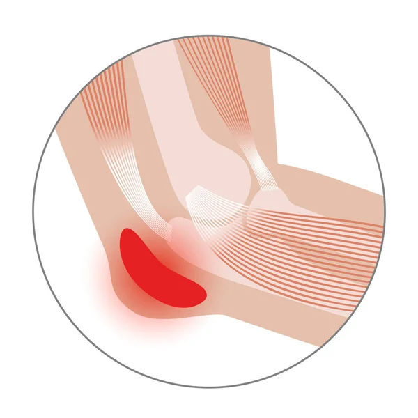 Studenten elleboog bursitis — Stockvector