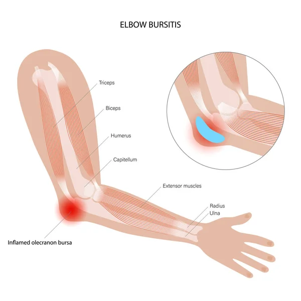 Studentská loketní bursitida — Stockový vektor