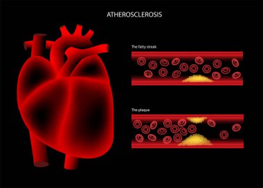 Kolesterol kalp hastalığı