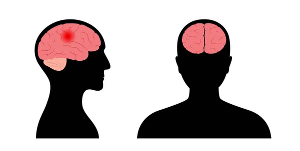 Νόσος του εγκεφάλου — Διανυσματικό Αρχείο