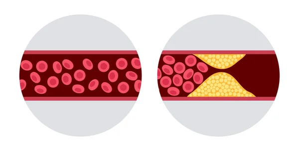 콜레스테롤 과 죽상 경화증 — 스톡 벡터