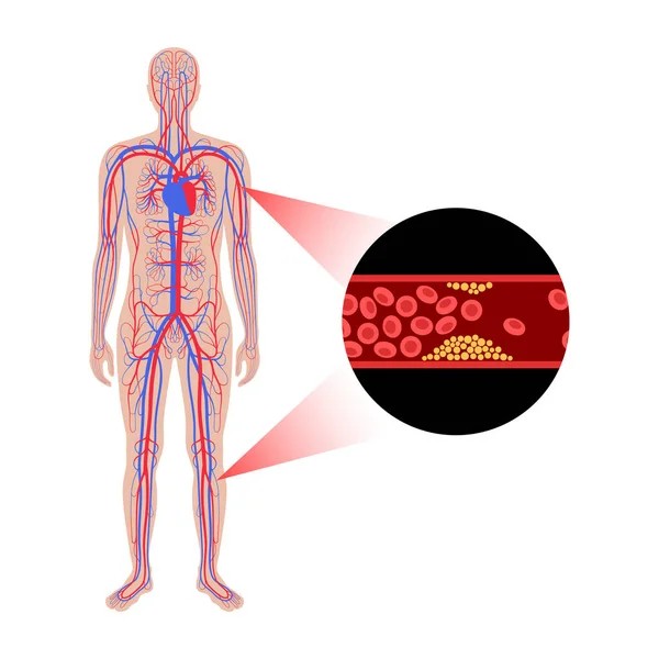 Enfermedad arterial periférica — Vector de stock