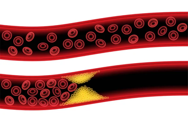 Cholestérol et athérosclérose — Image vectorielle