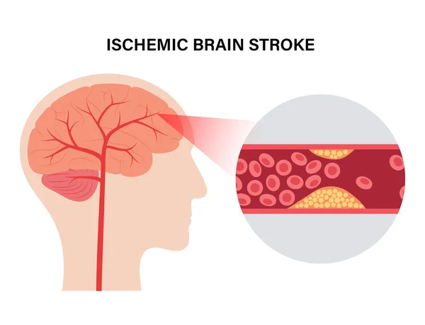 Інсульт мозку ішемічний — стоковий вектор