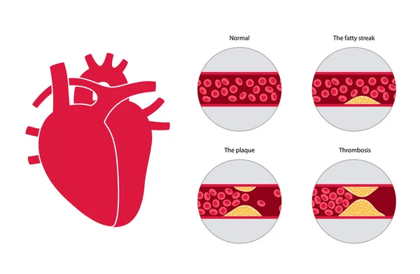 Colesterolo cardiopatia — Vettoriale Stock