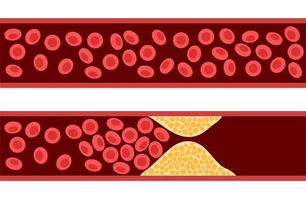 Cholesterol a ateroskleróza — Stockový vektor