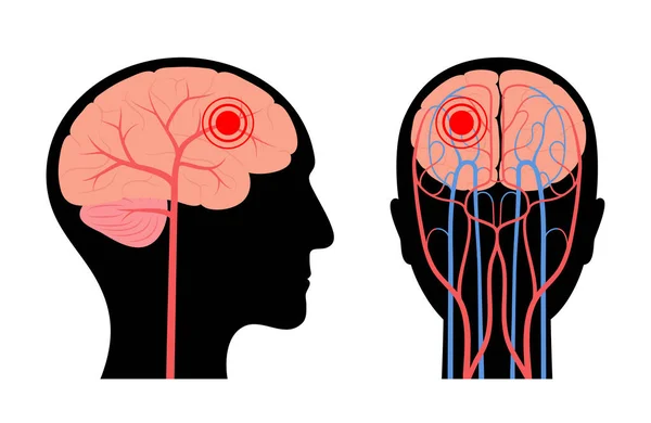 Beyin ağrısı hastalığı.