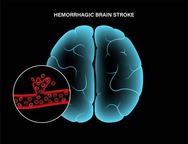 Кровоизлияние в мозг — стоковый вектор