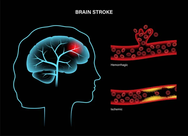 Инсульт и кровоизлияние в мозг — стоковый вектор