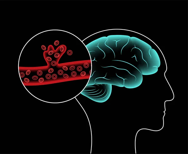 Acidente vascular cerebral hemorrágico — Vetor de Stock