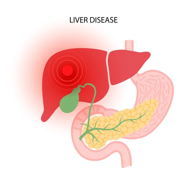 Liver disease concept — Stock Vector