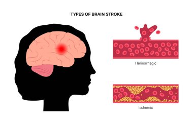 Brain stroke ishemic and hemorrhagic clipart