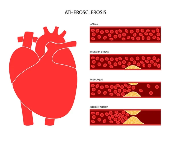 Colesterol doença cardíaca —  Vetores de Stock