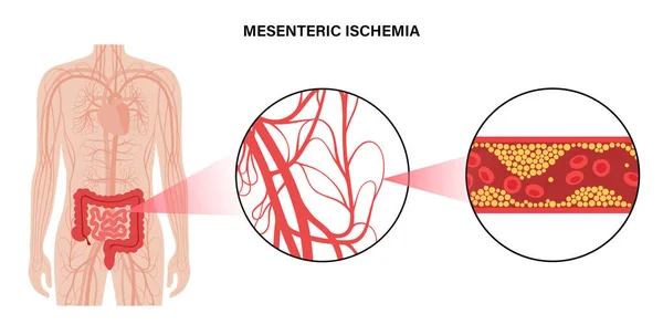 Mesentric ishemia ziekte — Stockvector
