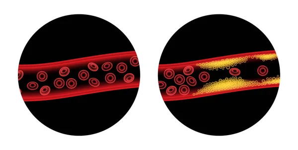 Cholesterol i miażdżyca — Wektor stockowy