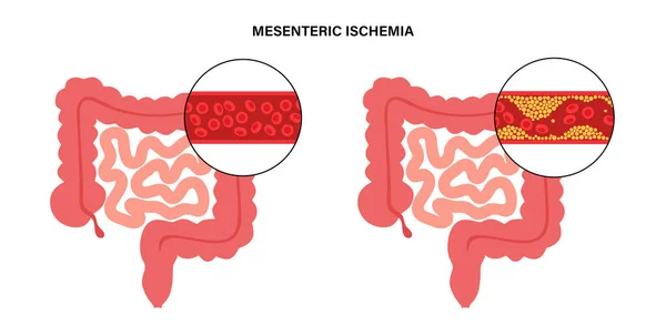 Enfermedad por ishemia mesentérica — Archivo Imágenes Vectoriales