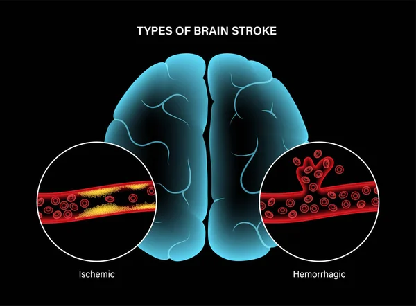 Инсульт и кровоизлияние в мозг — стоковый вектор