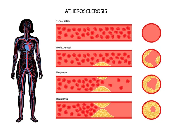 Cholesterol and atherosclerosis — Stock Vector