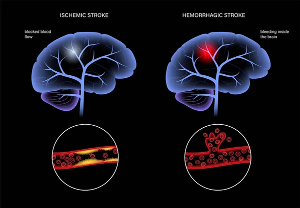 AVC cérébral hémorragique et hémorragique — Image vectorielle