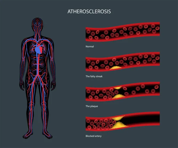 Koleszterin és atherosclerosis — Stock Vector