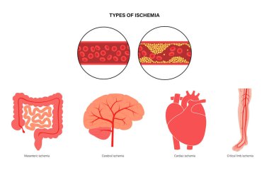 Types of ishemia clipart