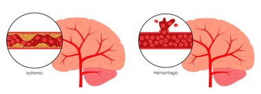 Brain stroke ishemic and hemorrhagic clipart
