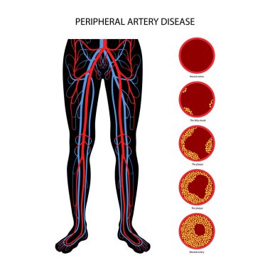 Peripheral artery disease clipart