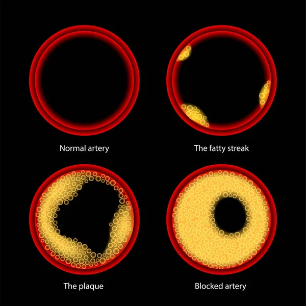 Cholesterol a ateroskleróza — Stockový vektor