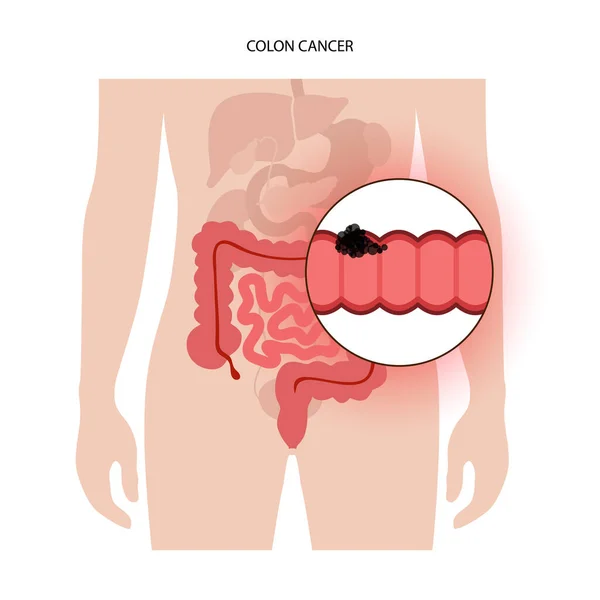 Estadio del cáncer de colon — Vector de stock