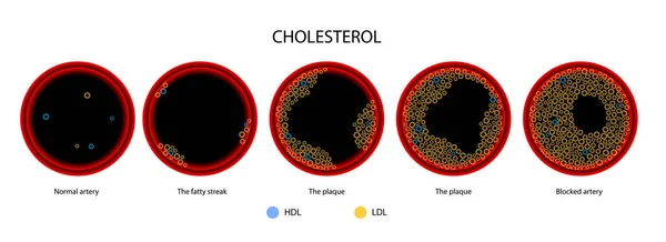 Kolesterol kan arteri — Stok Vektör