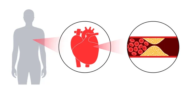 Colesterolo cardiopatia — Vettoriale Stock