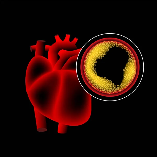 Χοληστερόλη καρδιοπάθεια — Διανυσματικό Αρχείο