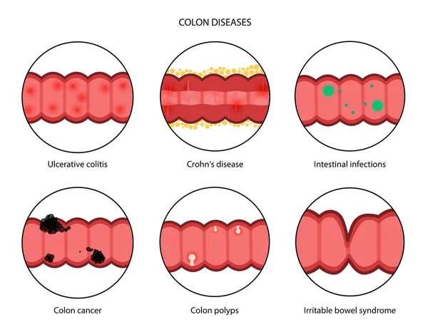 Concetto di malattie intestinali — Vettoriale Stock