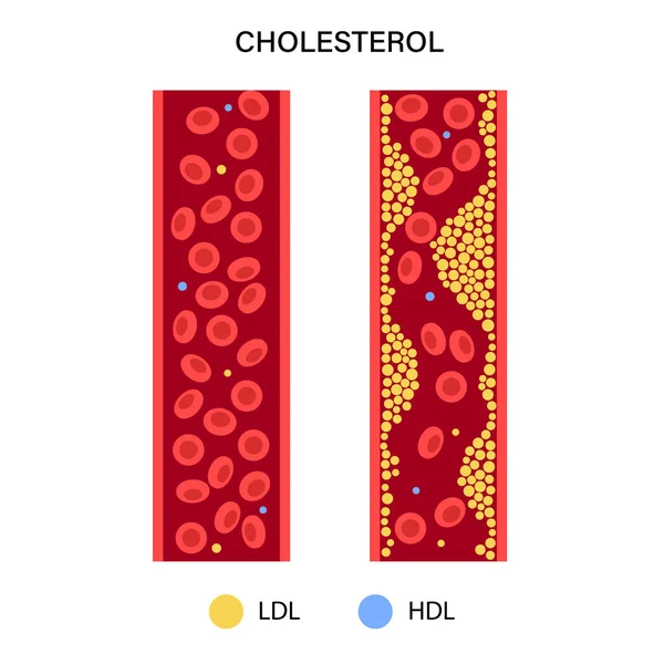 Холестерин в крови — стоковый вектор