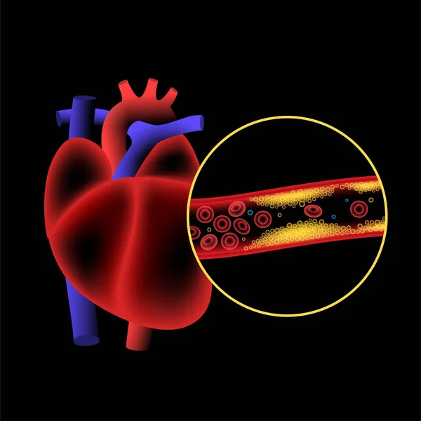 Χοληστερόλη καρδιοπάθεια — Διανυσματικό Αρχείο