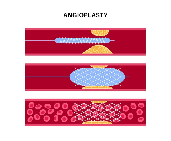 Angioplastie endoprothèse cardiaque — Image vectorielle