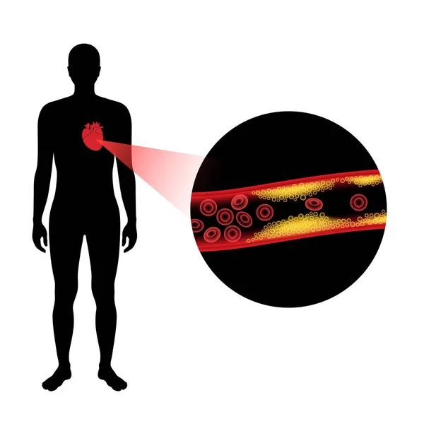 Cholesterin-Herzkrankheit — Stockvektor