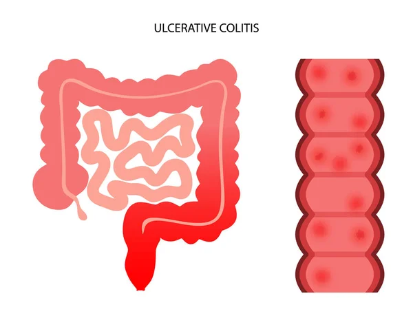 Colite ulcerosa intestinale — Vettoriale Stock