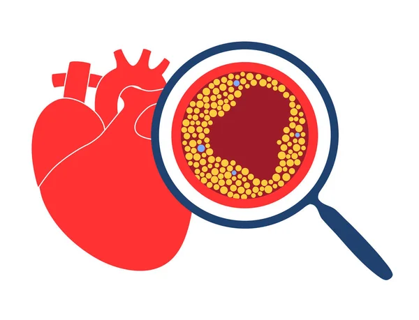 Cholesterol hartziekte — Stockvector