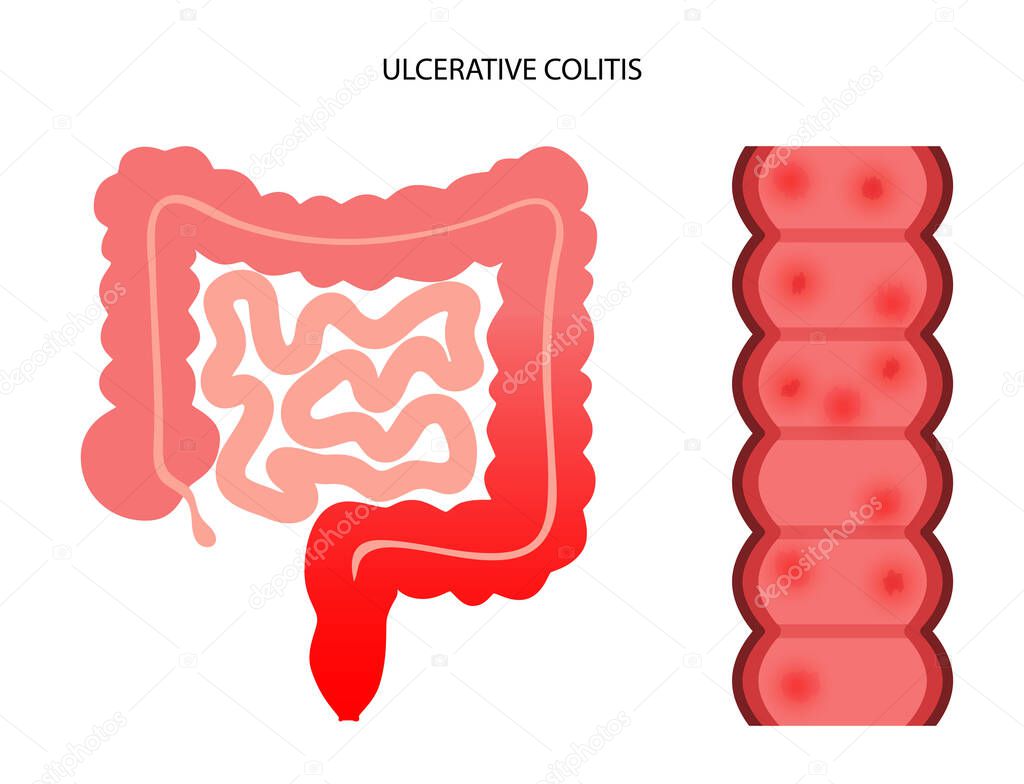 intestine ulcerative colitis