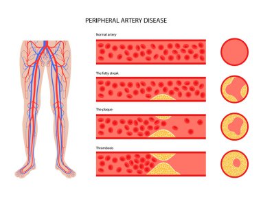 Peripheral artery disease clipart