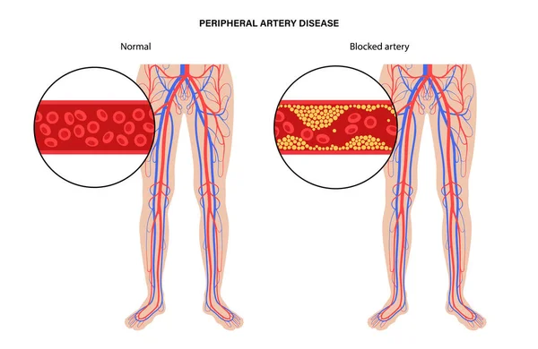 Peripheral artery disease — Stock Vector