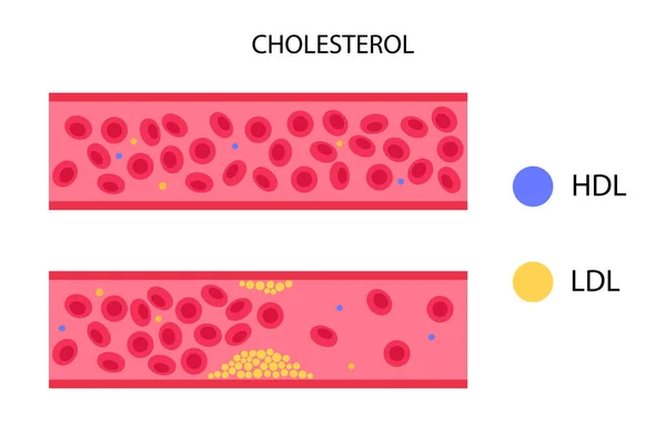 Colesterol arteria sanguínea — Archivo Imágenes Vectoriales