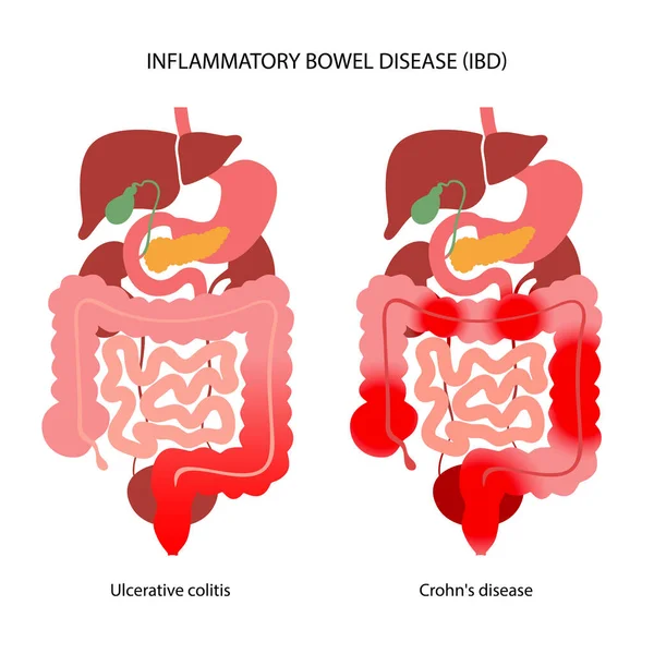 Malattia infiammatoria intestinale — Vettoriale Stock