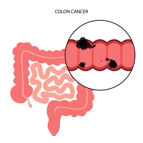 Colon cancer stage — Stock Vector
