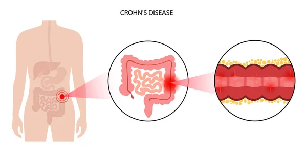 Chrons disease concept — Stock Vector