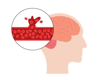 Beyin kanaması geçiriyor.