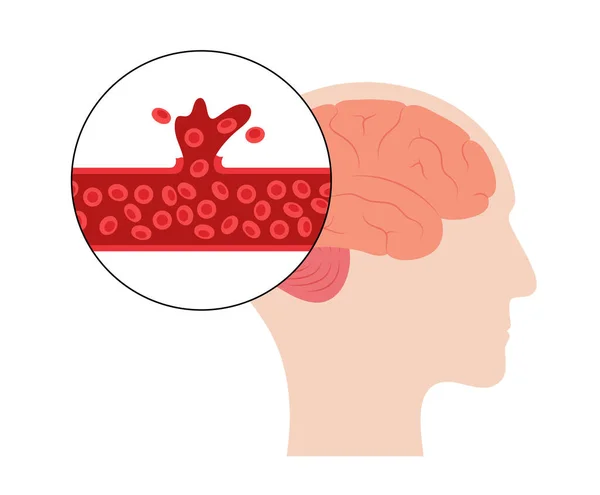 Hersenberoerte hemorragisch — Stockvector