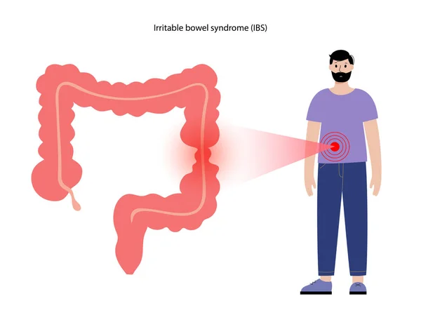 Síndrome del intestino irritable — Archivo Imágenes Vectoriales